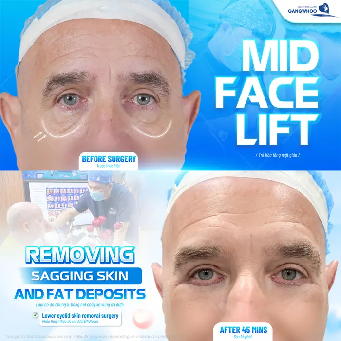 Phẫu Thuật Nâng Tầng Mặt Giữa (Midface Lift) Cải Thiện Bọng Mắt, Rãnh Lệ Và Má Chảy Xệ 3 Loại bỏ da chùng và bọng mắt chả xệ vùng mí dưới sau 45 phút đôi mắt đã trẻ trung trở lại