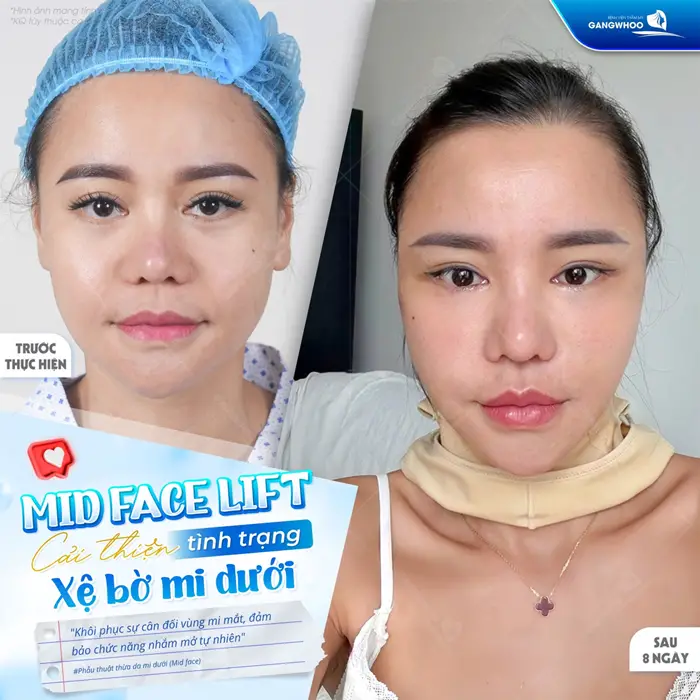 Midface lift cải thiện tình trạng xệ bờ mi dưới hiệu quả 