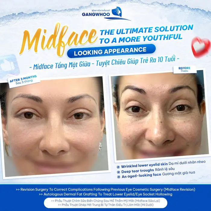 Midface tầng mặt giữa tuyệt chiêu giúp gương mặt trẻ ra 10 tuổi 