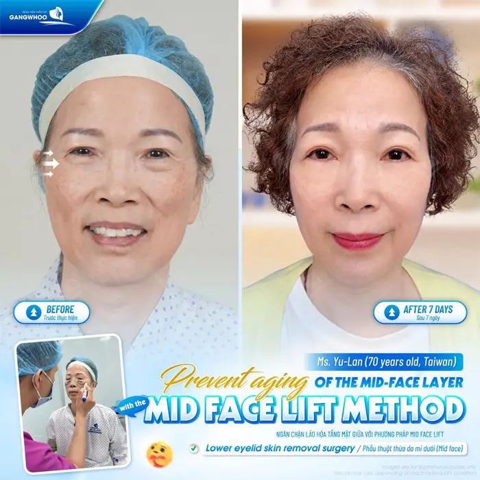 Ngăn chặn lão hóa tầng mặt giữa với phương pháp Midface nhan sắc trẻ trung và rạng rỡ hơn 