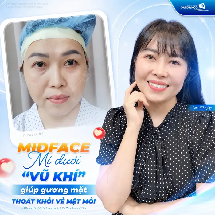 Phẫu thuật mí dưới Midface giúp gương mặt thoát khỏi vẻ mệt mỏi sau phẫu thuật 