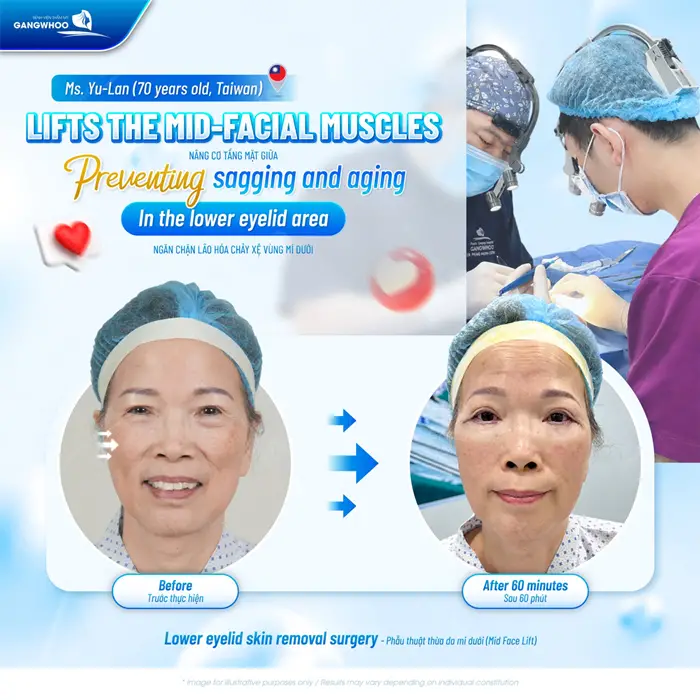 Nâng cơ trẻ hóa tầng mặt giữa khôi phục nét đẹp trẻ trung cho diện mạo tổng thể