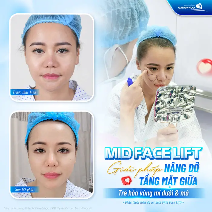 Phẫu Thuật Nâng Tầng Mặt Giữa (Midface Lift) Cải Thiện Bọng Mắt, Rãnh Lệ Và Má Chảy Xệ 4 Giải pháp nâng đỡ tầng mặt giữa trẻ hóa khuôn mặt an toàn và hiệu quả