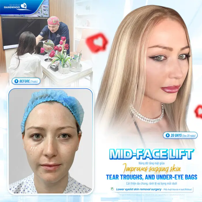 Phẫu Thuật Nâng Tầng Mặt Giữa (Midface Lift) Cải Thiện Bọng Mắt, Rãnh Lệ Và Má Chảy Xệ 5 Nâng cơ tầng mặt giữa cải thiện da chùng, rãnh lệ và bọng mí mắt dưới một cách an toàn và hiệu quả