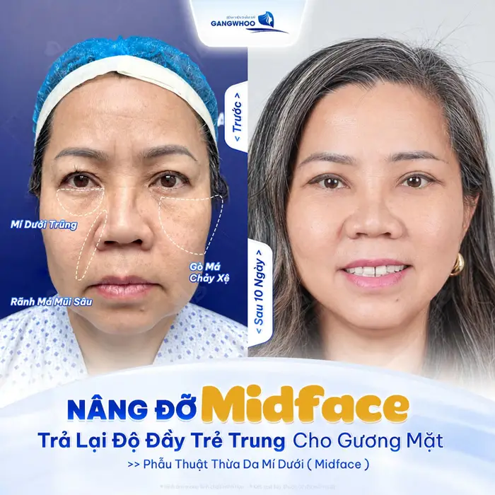 Nâng đỡ Midface tầng mặt giữ trả lại độ đầy trẻ trung cho gương mặt