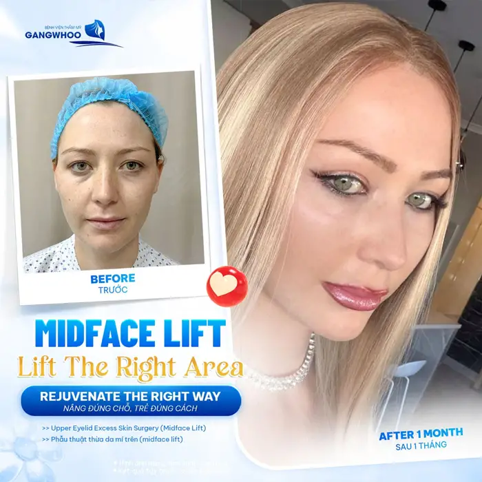 Trẻ hóa tầng mặt giữa Midface nâng đúng chỗ, trẻ hóa đúng điểm diện mạo cải thiện thêm phần trẻ trung