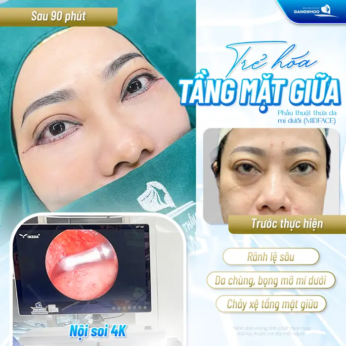 Trẻ hóa tầng mặt giữa phẫu thuật thừa da mí dưới Mid face cải thiện khuyết điểm toàn gương mặt