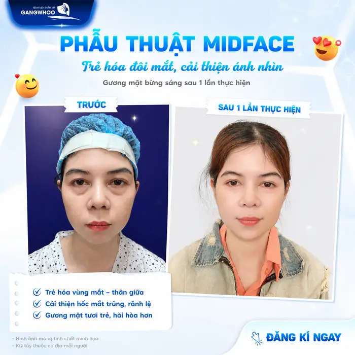 Phẫu Thuật Nâng Tầng Mặt Giữa (Midface Lift) Cải Thiện Bọng Mắt, Rãnh Lệ Và Má Chảy Xệ 2 Phẫu thuật Midface trẻ hóa đôi mắt cải thiện ánh nhìn gương mặt đẹp bừng sáng sau chỉ 1 lần thực hiện