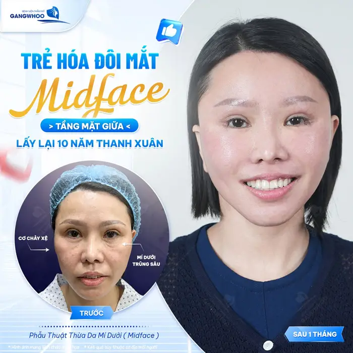 Phẫu Thuật Nâng Tầng Mặt Giữa (Midface Lift) Cải Thiện Bọng Mắt, Rãnh Lệ Và Má Chảy Xệ 7 Trẻ hóa đôi mắt Midface tầng mặt giữa lấy lại 10 năm thanh xuân