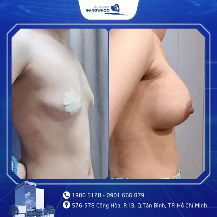 3 Things Foreigners Must Know Before Getting Breast Augmentation in Vietnam 7 khach hang nang nguc dat tui 107