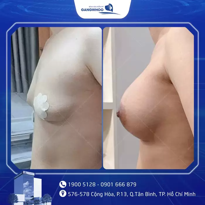 3 Things Foreigners Must Know Before Getting Breast Augmentation in Vietnam 6 khach hang nang nguc dat tui 108