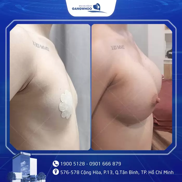 3 Things Foreigners Must Know Before Getting Breast Augmentation in Vietnam 11 khach hang nang nguc dat tui 96