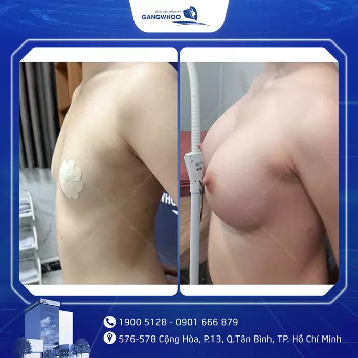 3 Things Foreigners Must Know Before Getting Breast Augmentation in Vietnam 12 khach hang nang nguc dat tui 97