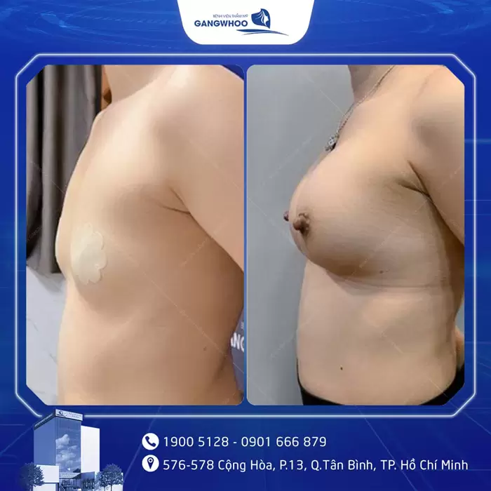 3 Things Foreigners Must Know Before Getting Breast Augmentation in Vietnam 8 khach hang nang nguc dat tui 98