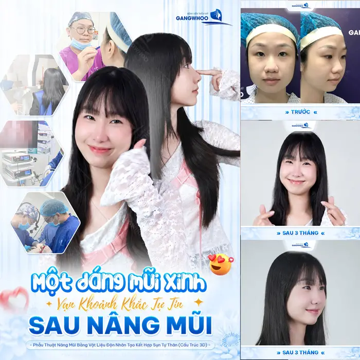 1 dáng mũi đẹp vạn khoảnh khắc thêm tự tin sau nâng mũi 