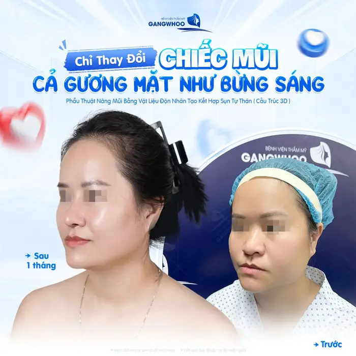 Chỉ thay đổi nhỏ ở chiếc mũi cả gương mặt đẹp bừng sáng
