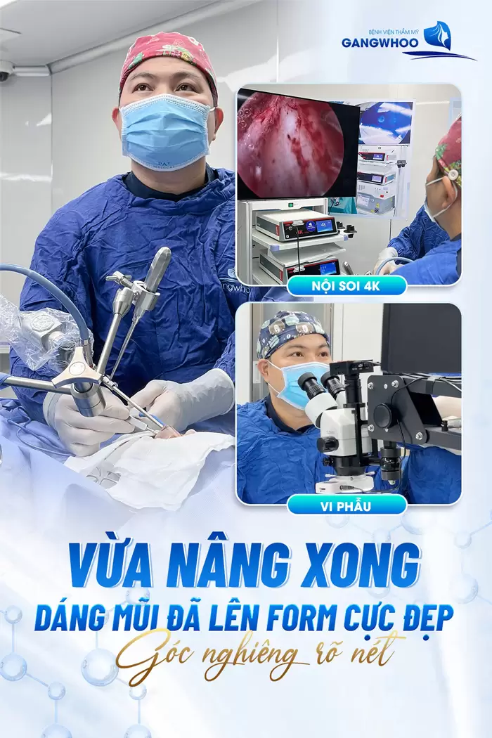 Phẫu Thuật Nâng Mũi Nội Soi 4K Là Gì? Ưu Điểm Và Chi Phí Năm 2025 35 Áp dụng công nghệ vi phẫu, nội soi 4K sẽ giúp giảm đau, giảm sưng nhanh chóng