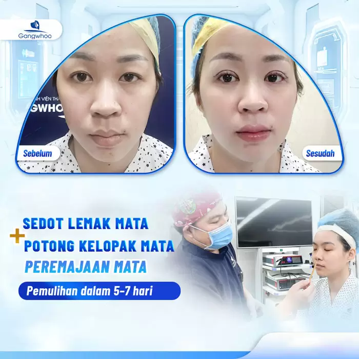 in lay mo mat noi soi 1