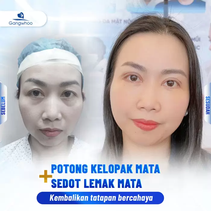 in lay mo mat noi soi 4