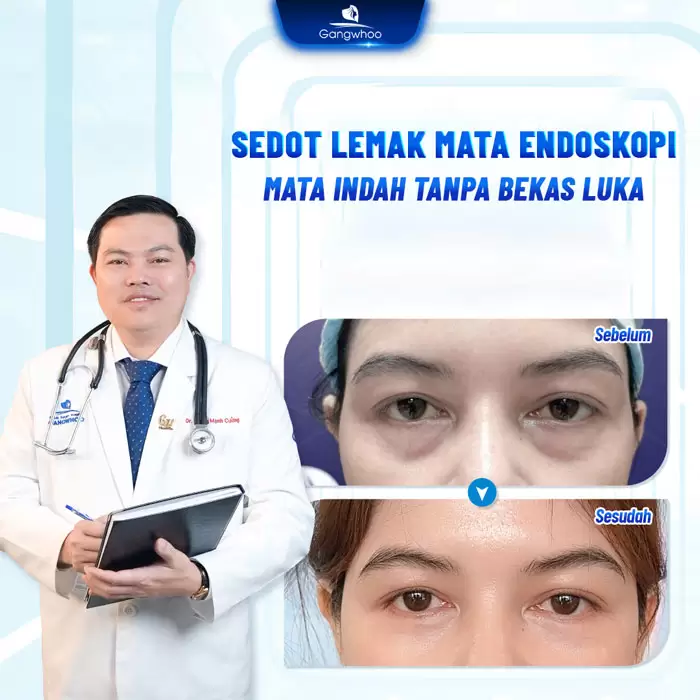 in lay mo mat noi soi 6