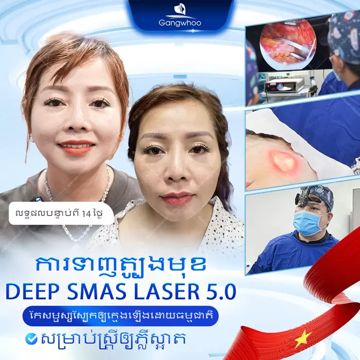 km cang da mat deep smas laser 1
