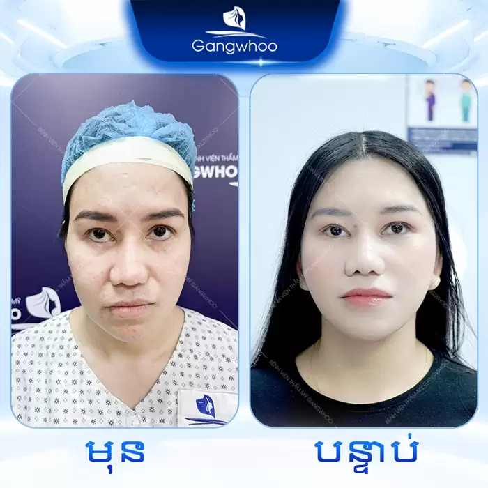 km cang da mat deep smas laser 2