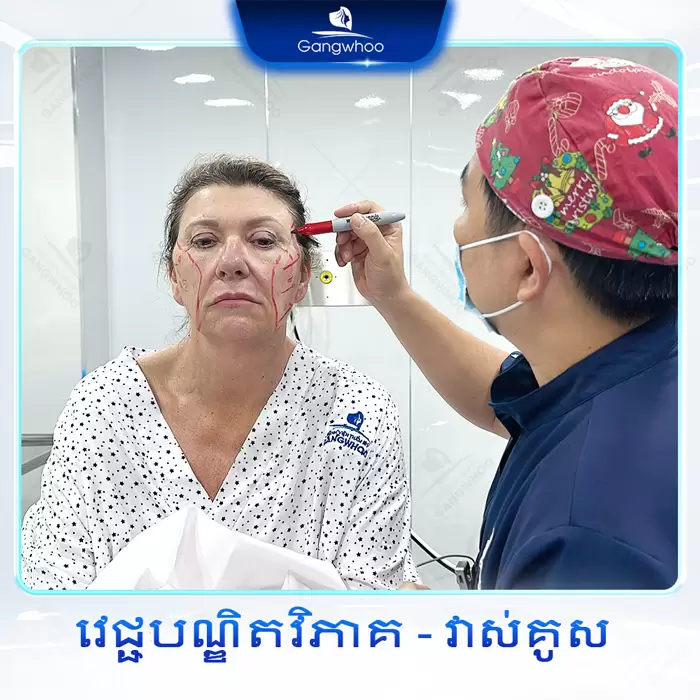 km cang da mat deep smas laser 3