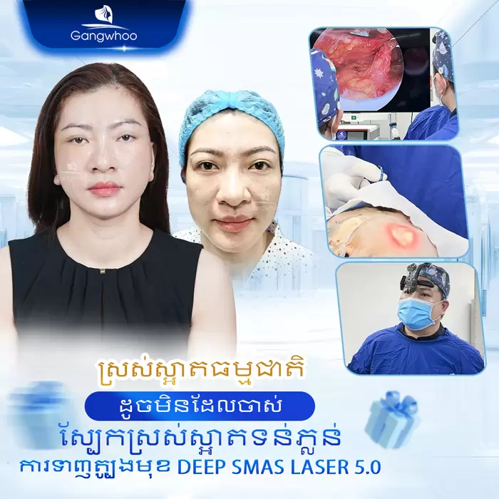 km cang da mat deep smas laser 4