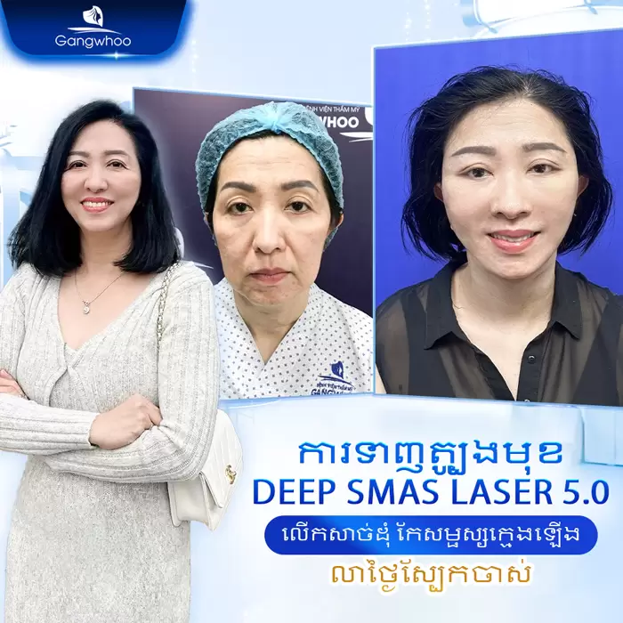 km cang da mat deep smas laser 6
