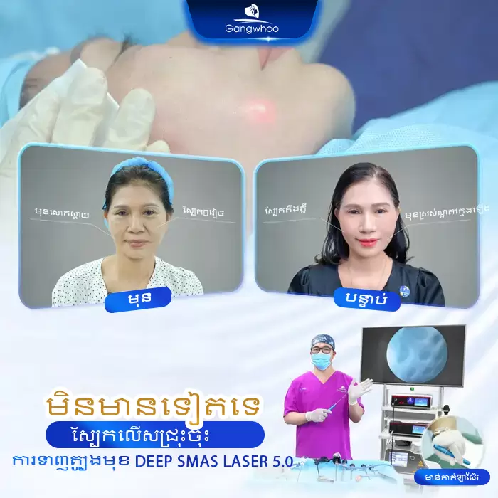 km cang da mat deep smas laser 7