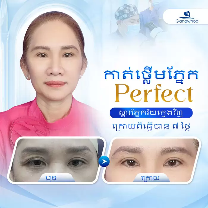 km cat mi perfect 1