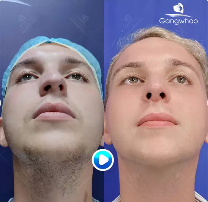 km chinh hinh vach ngan 8