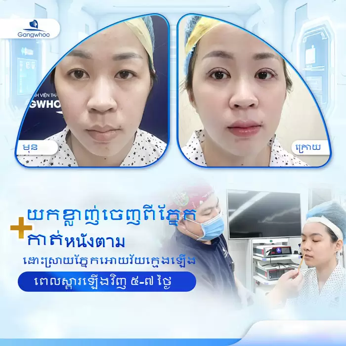 km lay mo mat noi soi 1
