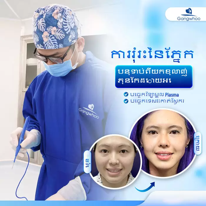 km lay mo mat noi soi 2