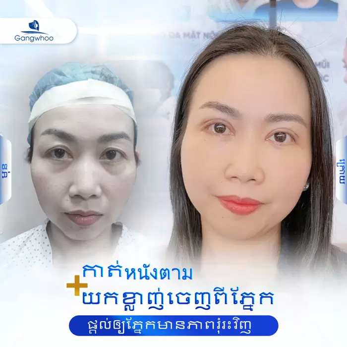 km lay mo mat noi soi 4