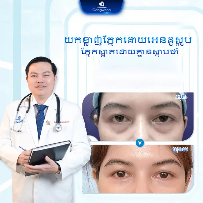 km lay mo mat noi soi 6