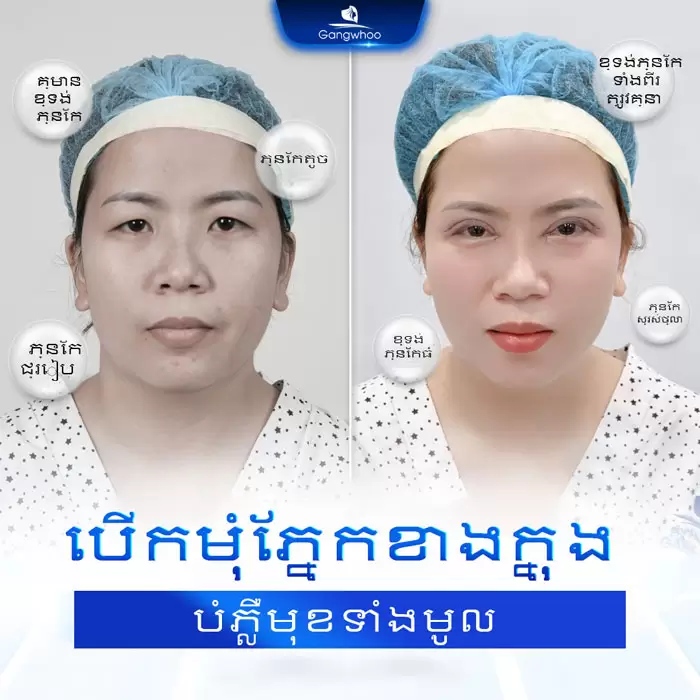 km mo goc mat trong 5