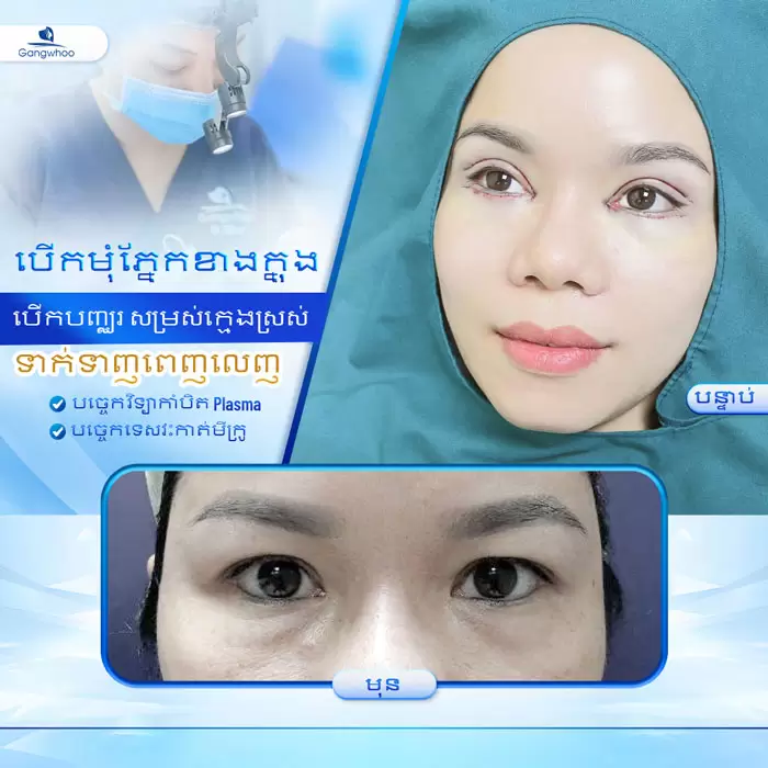 km mo goc mat trong 6