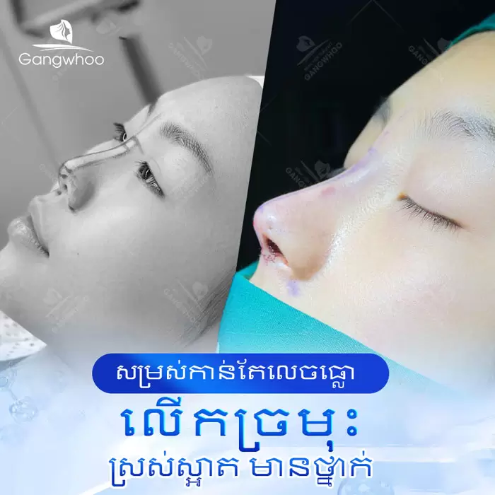 km nang mui bang chi 10