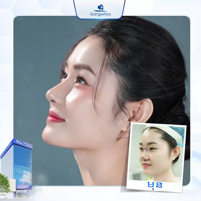 km nang mui cau truc 1