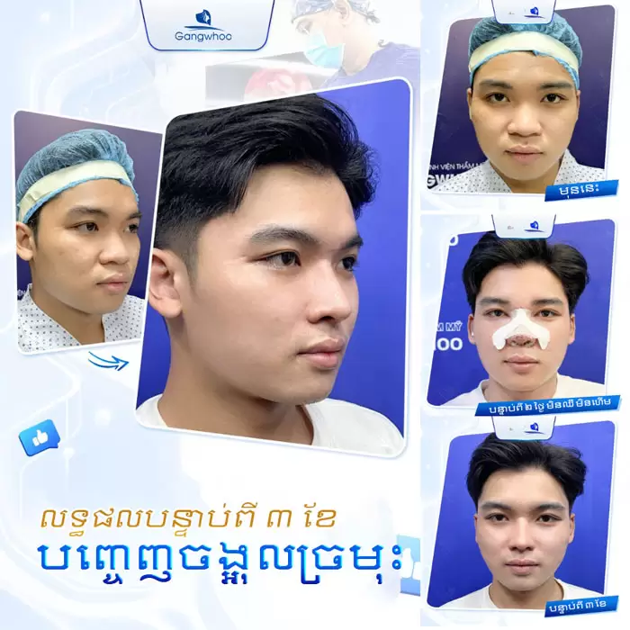 km nang mui cau truc 2