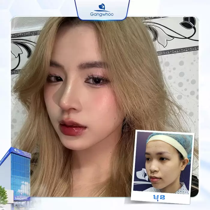 km nang mui cau truc 3