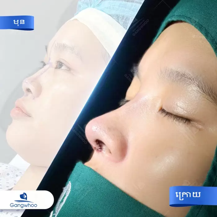 ការពែទ្យកែសម្ផស្សច្រមុះបែបកូរ៉េ – អាថ៌កំបាំងនៃការមានទម្រង់ច្រមុះបែបកូរ៉េ 1 km nang mui han quoc 1