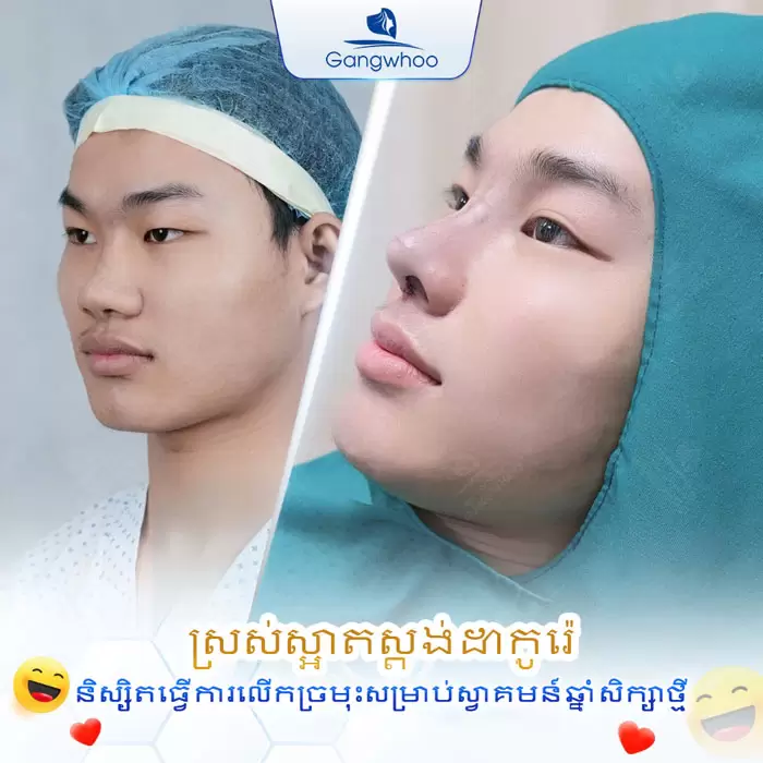 ការពែទ្យកែសម្ផស្សច្រមុះបែបកូរ៉េ – អាថ៌កំបាំងនៃការមានទម្រង់ច្រមុះបែបកូរ៉េ 4 km nang mui han quoc 4