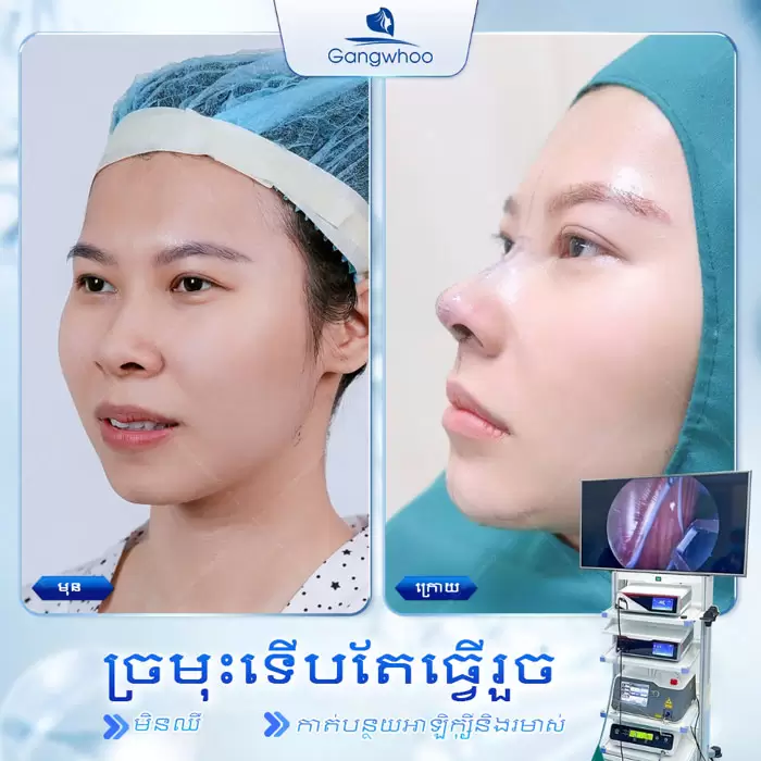 ការពែទ្យកែសម្ផស្សច្រមុះបែបកូរ៉េ – អាថ៌កំបាំងនៃការមានទម្រង់ច្រមុះបែបកូរ៉េ 11 km nang mui han quoc 6