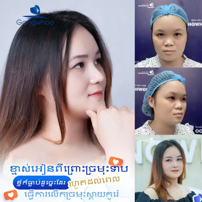 ការពែទ្យកែសម្ផស្សច្រមុះបែបកូរ៉េ – អាថ៌កំបាំងនៃការមានទម្រង់ច្រមុះបែបកូរ៉េ 9 km nang mui han quoc 8