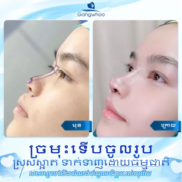 ការពែទ្យកែសម្ផស្សច្រមុះបែបកូរ៉េ – អាថ៌កំបាំងនៃការមានទម្រង់ច្រមុះបែបកូរ៉េ 3 km nang mui han quoc 9