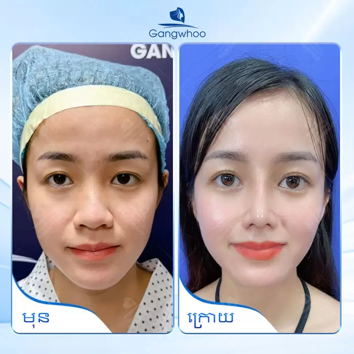 km nang mui nanoform 10