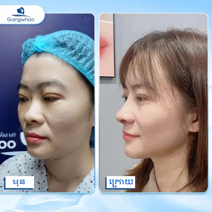 km nang mui nanoform 11