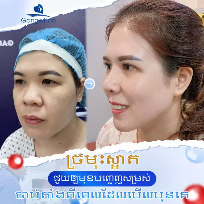 km nang mui nanoform 2